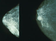 Mamografías mostrando una mama normal (izq.) y una con cáncer (der.)